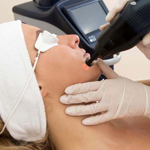 CO2 laser treatment at Face and Body Clinic, Williamstown